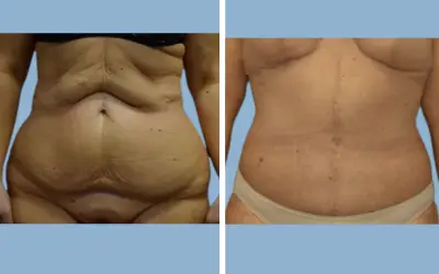 Before and After